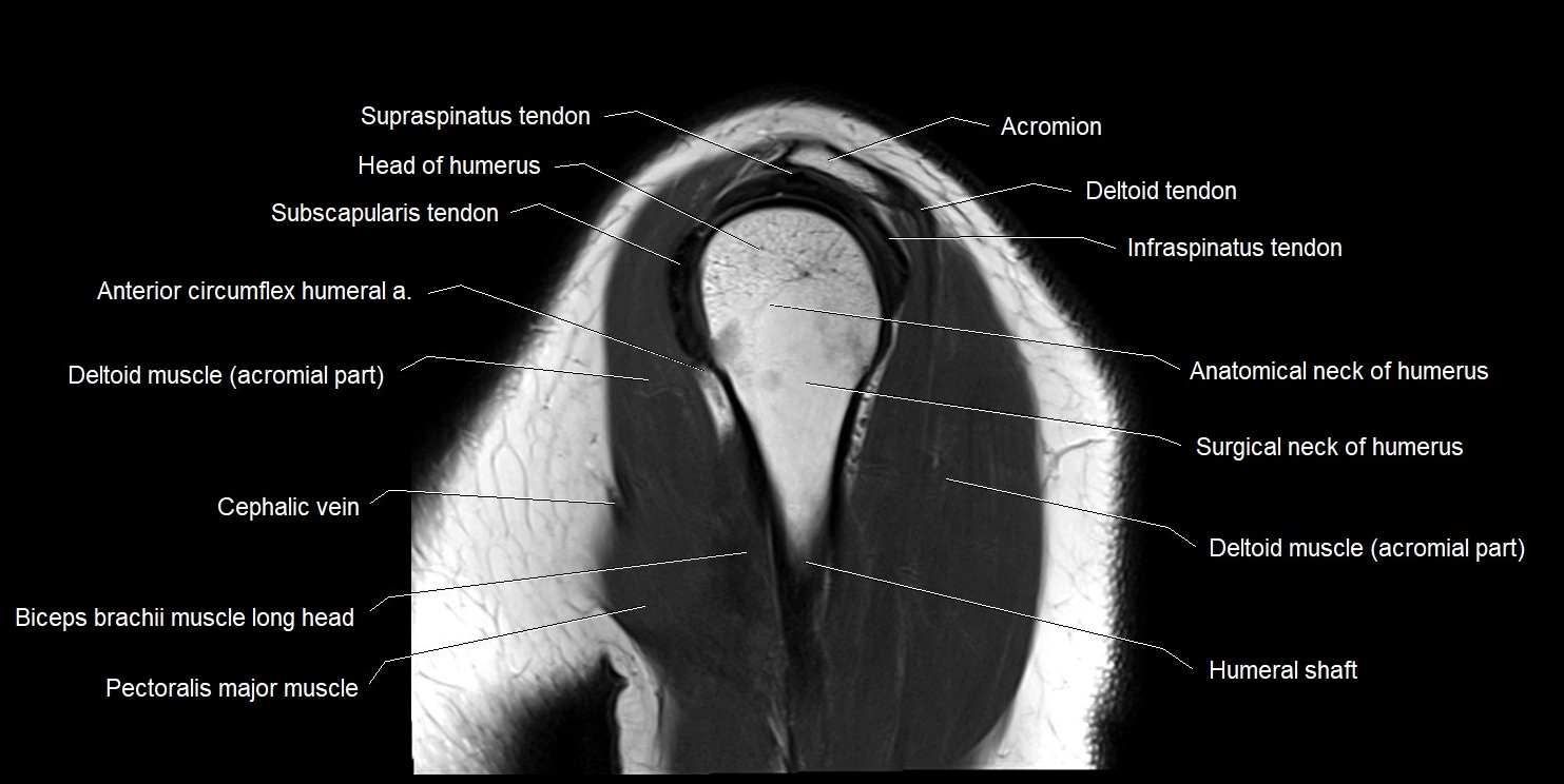 mri shoulder sagittal cross sectional anatomy image 14.webp